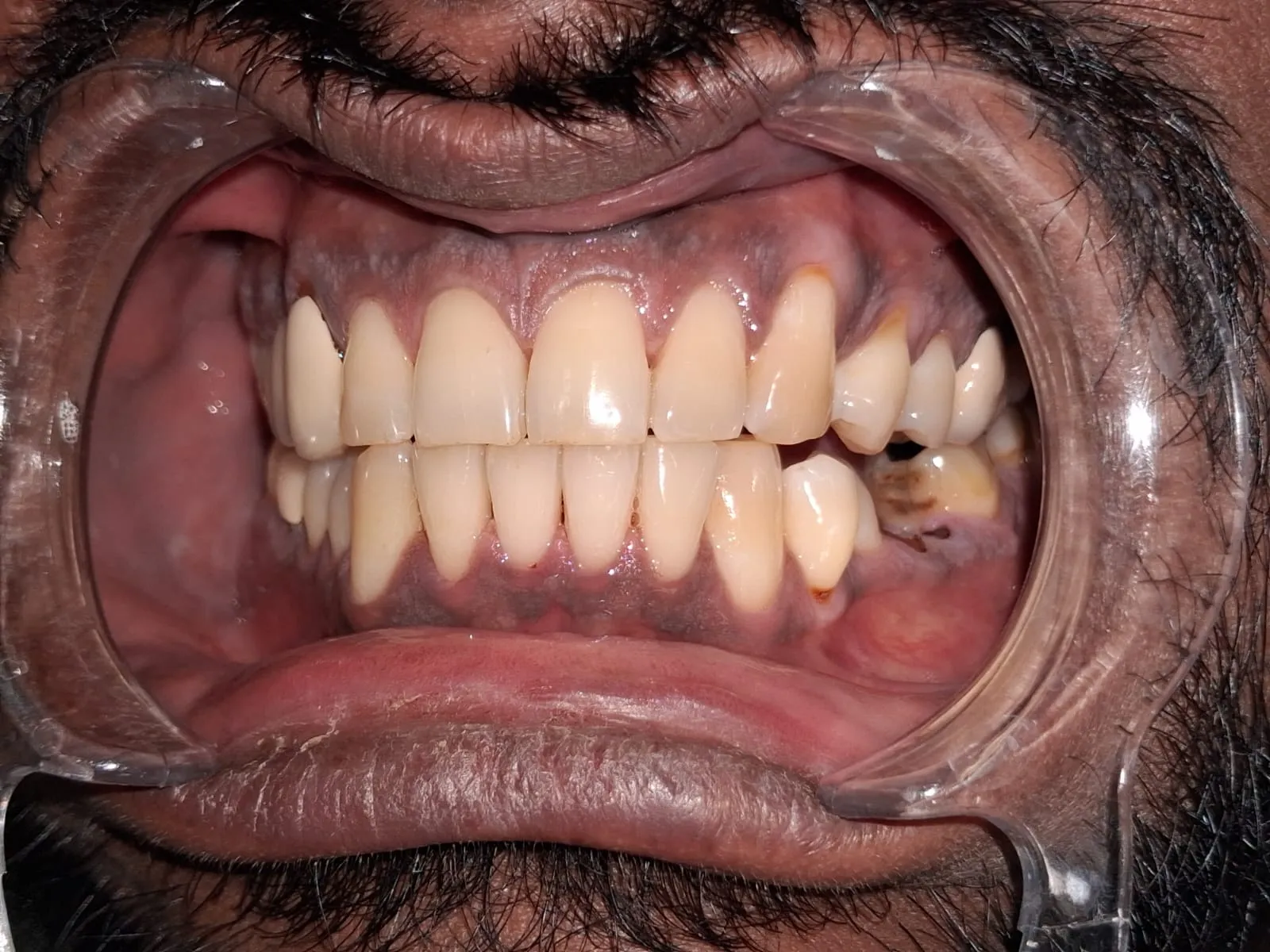 After professional scaling