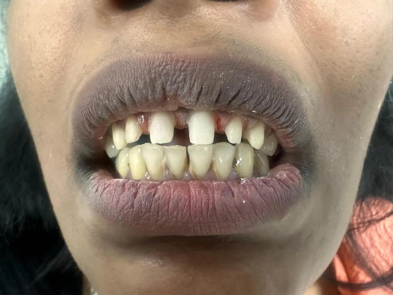 Before smile designing